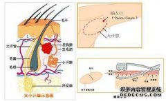 大连腋臭微创手术后遗症