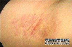 大连是什么原因引起女性腋臭的