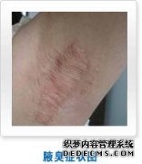 大连那些可以治疗腋臭的小偏方